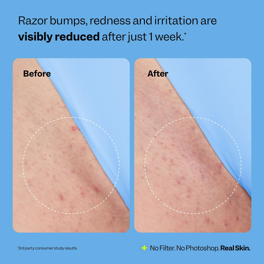 Peach Slices Ingrown Hair Treatment – Smoothing Solution with BHA, AHA & Niacinamide